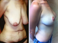 Post Bariatric Weight Loss Surgery Patient Before & After Photo 1