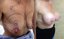 Body Procedures Patient Before & After Photo 1