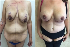 Post Bariatric Weight Loss Surgery Patient Before & After Photo 1