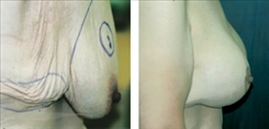 Body Procedures Patient Before & After Photo 1