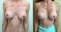 Breast Implant Revision Patient Before & After Photo 1