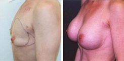 Silicone Gel Implants Patient Before & After Photo 1