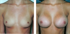 Silicone Gel Implants Patient Before & After Photo 1