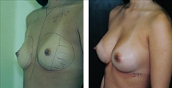 Silicone Gel Implants Patient Before & After Photo 1