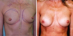 Silicone Gel Implants Patient Before & After Photo 1