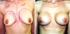 Silicone Gel Implants Patient Before & After Photo 1