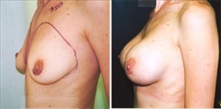 Silicone Gel Implants Patient Before & After Photo 1