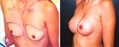 Silicone Gel Implants Patient Before & After Photo 1