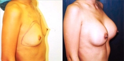 Silicone Gel Implants Patient Before & After Photo 1