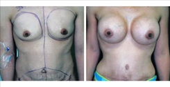 Silicone Gel Implants Patient Before & After Photo 1