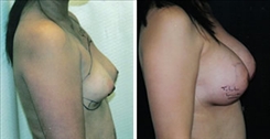 Tubular Breast Deformity Patient Before & After Photo 1