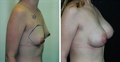 Tubular Breast Deformity Patient Before & After Photo 1