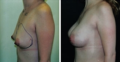 Tubular Breast Deformity Patient Before & After Photo 1