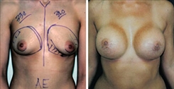 Tubular Breast Deformity Patient Before & After Photo 1