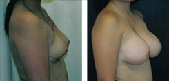 Tubular Breast Deformity Patient Before & After Photo 1