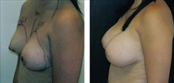 Tubular Breast Deformity Patient Before & After Photo 1