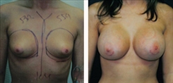 Tubular Breast Deformity Patient Before & After Photo 1