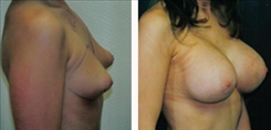 Tubular Breast Deformity Patient Before & After Photo 1