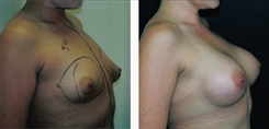 Tubular Breast Deformity Patient Before & After Photo 1