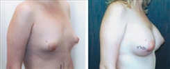 Tubular Breast Deformity Patient Before & After Photo 1