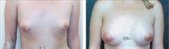 Tubular Breast Deformity Patient Before & After Photo 1