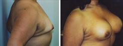 Tubular Breast Deformity Patient Before & After Photo 1