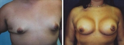 Tubular Breast Deformity Patient Before & After Photo 1