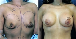 Tubular Breast Deformity Patient Before & After Photo 1