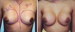 Tubular Breast Deformity Patient Before & After Photo 1