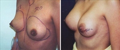 Tubular Breast Deformity Patient Before & After Photo 1