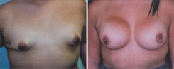 Tubular Breast Deformity Patient Before & After Photo 1