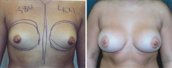 Tubular Breast Deformity Patient Before & After Photo 1