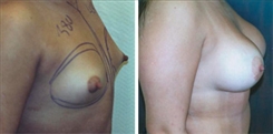 Tubular Breast Deformity Patient Before & After Photo 1