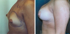 Tubular Breast Deformity Patient Before & After Photo 1