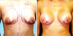 Tubular Breast Deformity Patient Before & After Photo 1