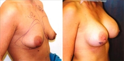 Tubular Breast Deformity Patient Before & After Photo 1