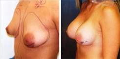 Tubular Breast Deformity Patient Before & After Photo 1