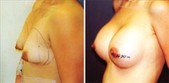 Tubular Breast Deformity Patient Before & After Photo 1