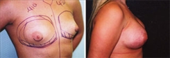 Tubular Breast Deformity Patient Before & After Photo 1