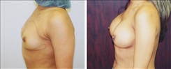 Tubular Breast Deformity Patient Before & After Photo 1