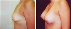 Tubular Breast Deformity Patient Before & After Photo 1