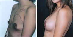 Tubular Breast Deformity Patient Before & After Photo 1