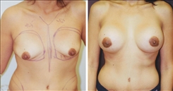 Tubular Breast Deformity Patient Before & After Photo 1