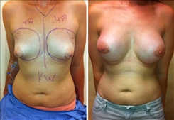 Breast Procedures Patient Before & After Photo 1