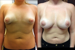 Breast Procedures Patient Before & After Photo 1