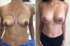 Tubular Breast Deformity Patient Before & After Photo 1