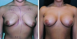 Tubular Breast Deformity Patient Before & After Photo 1