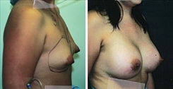 Tubular Breast Deformity Patient Before & After Photo 1