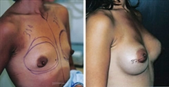 Tubular Breast Deformity Patient Before & After Photo 1