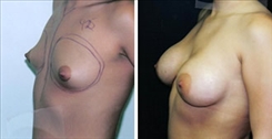 Tubular Breast Deformity Patient Before & After Photo 1